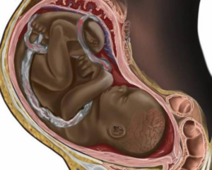 zwarte foetus